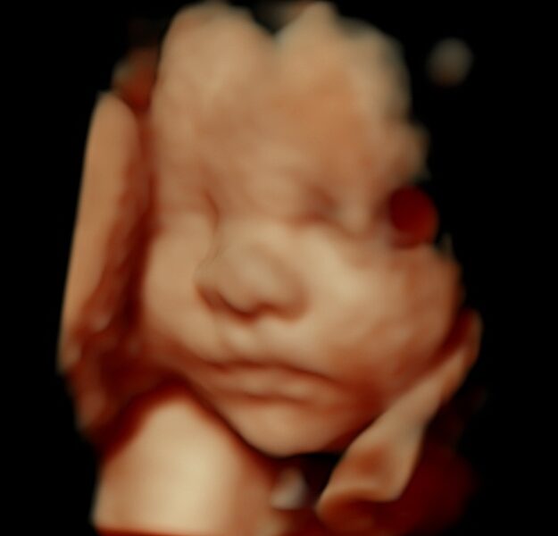 3D 4D HDLive Ultrasound – Cherished Memories